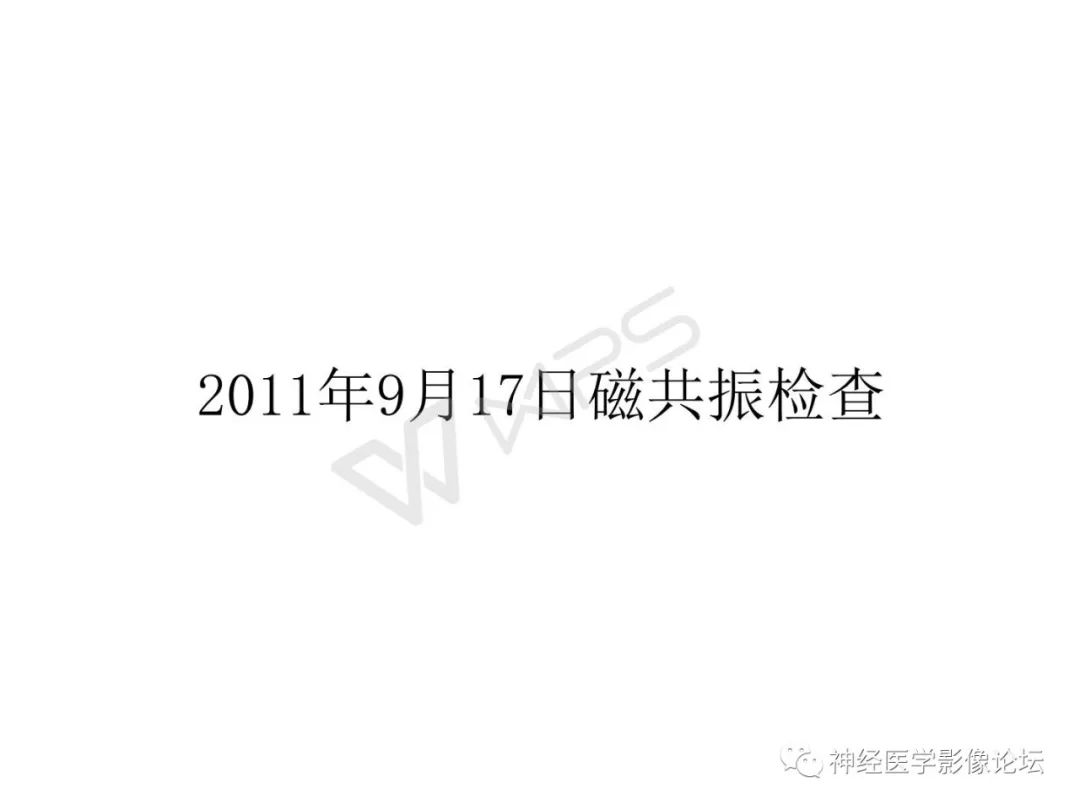 【病例】下丘脑节细胞胶质瘤一例MR影像表现