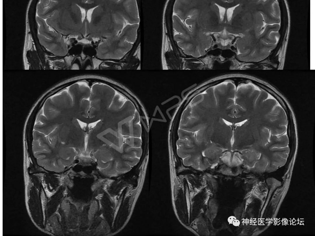 【病例】下丘脑节细胞胶质瘤一例MR影像表现