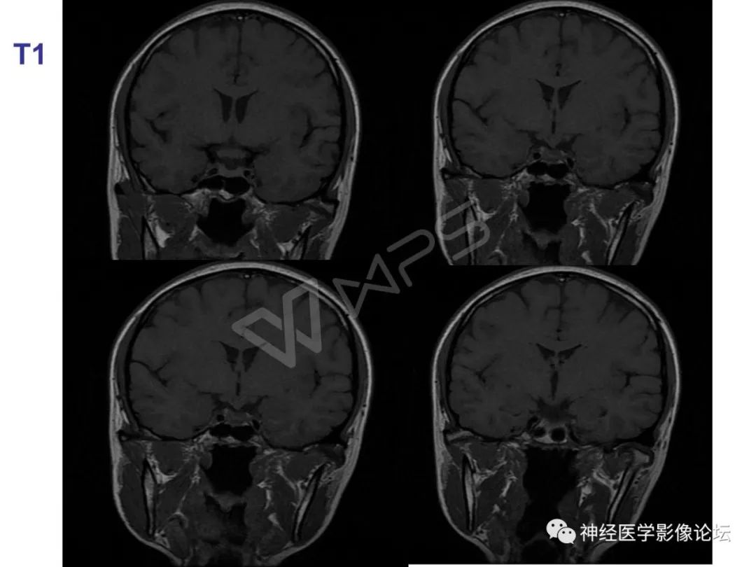 【病例】下丘脑节细胞胶质瘤一例MR影像表现