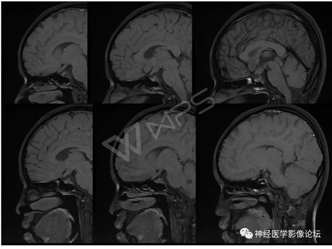 【病例】下丘脑节细胞胶质瘤一例MR影像表现