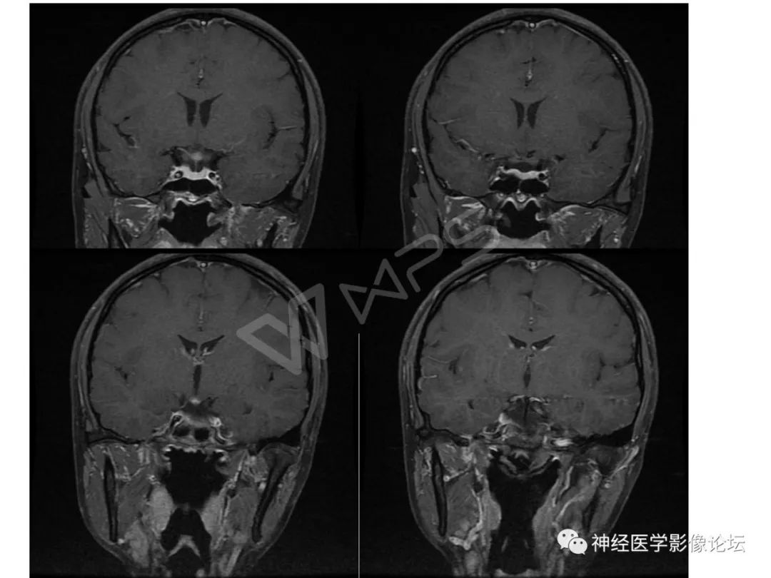 【病例】下丘脑节细胞胶质瘤一例MR影像表现