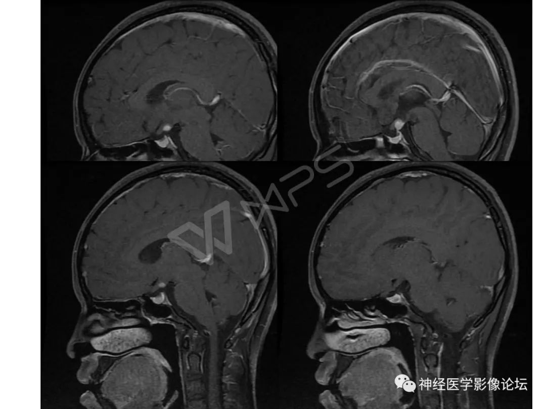 【病例】下丘脑节细胞胶质瘤一例MR影像表现