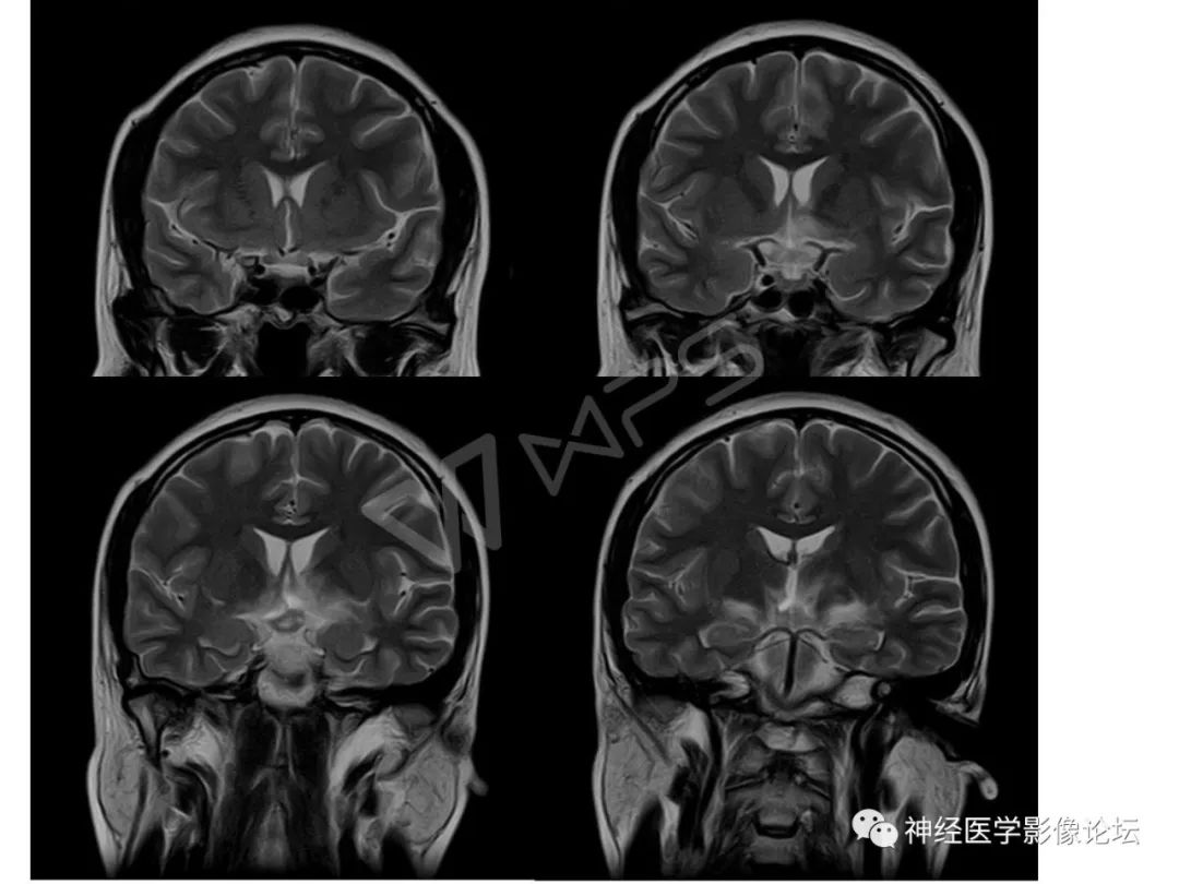 【病例】下丘脑节细胞胶质瘤一例MR影像表现