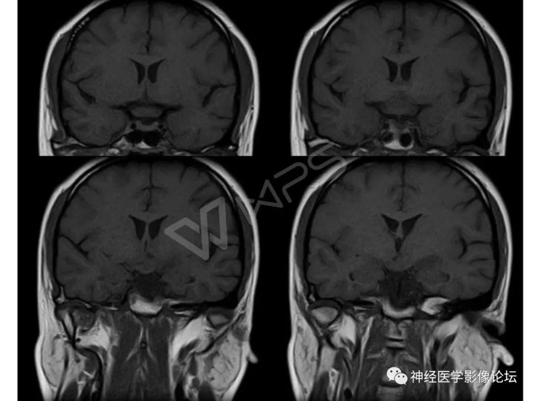 【病例】下丘脑节细胞胶质瘤一例MR影像表现