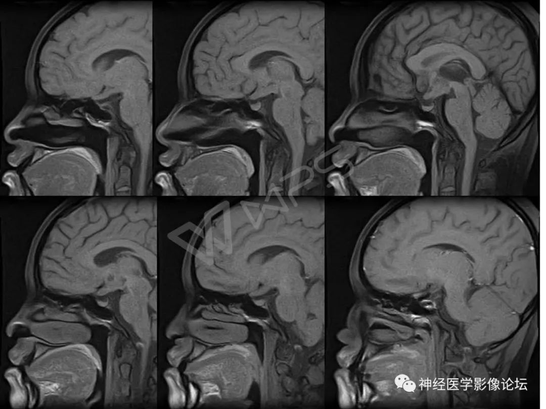 【病例】下丘脑节细胞胶质瘤一例MR影像表现