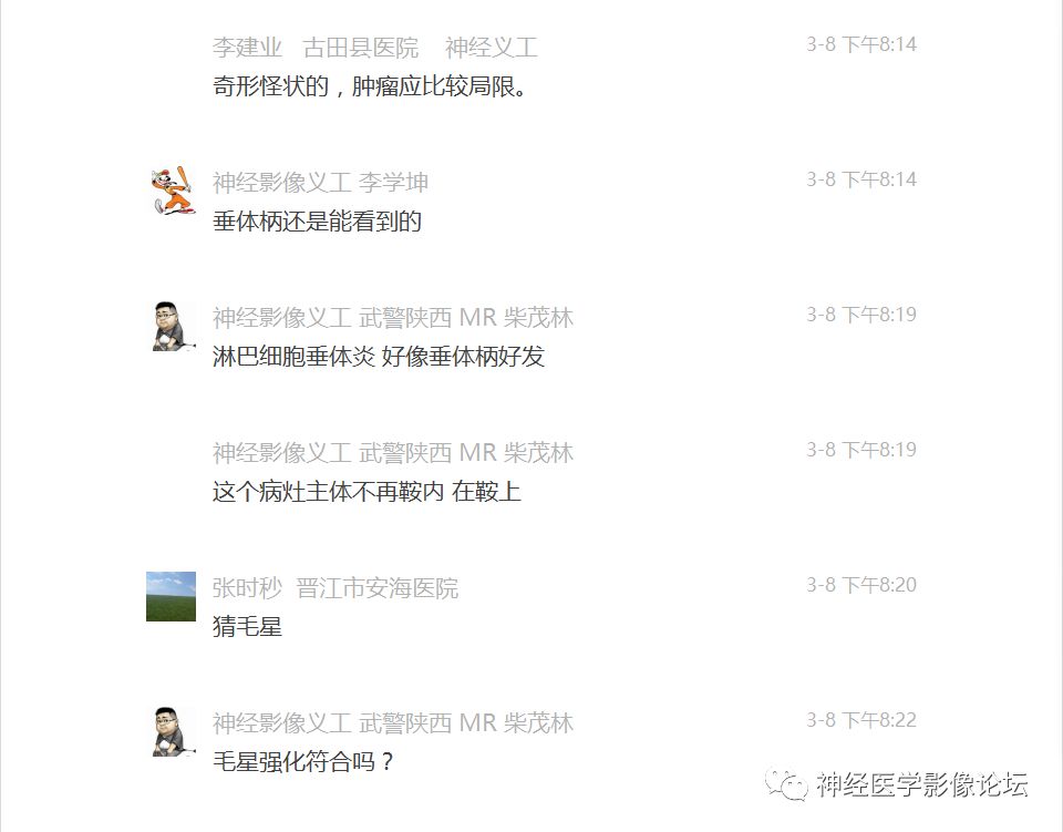 【病例】下丘脑节细胞胶质瘤一例MR影像表现