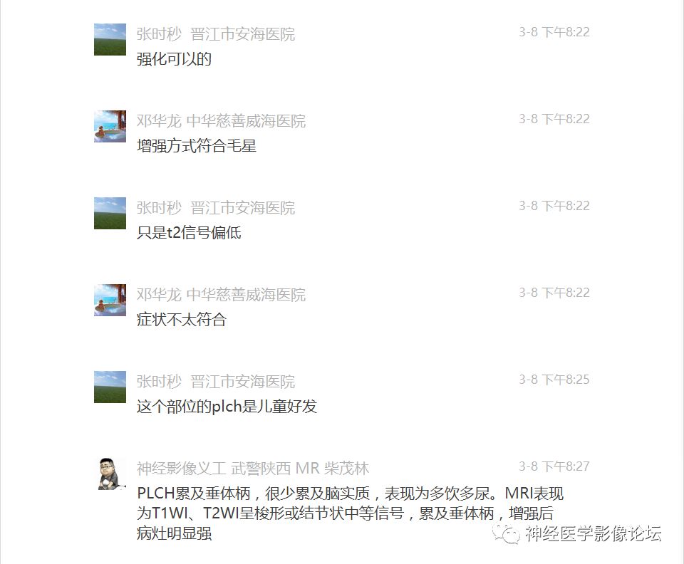 【病例】下丘脑节细胞胶质瘤一例MR影像表现