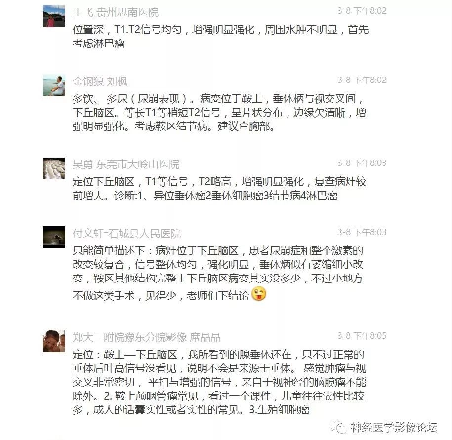 【病例】下丘脑节细胞胶质瘤一例MR影像表现