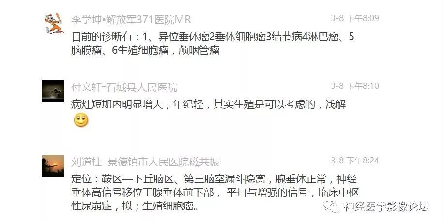 【病例】下丘脑节细胞胶质瘤一例MR影像表现