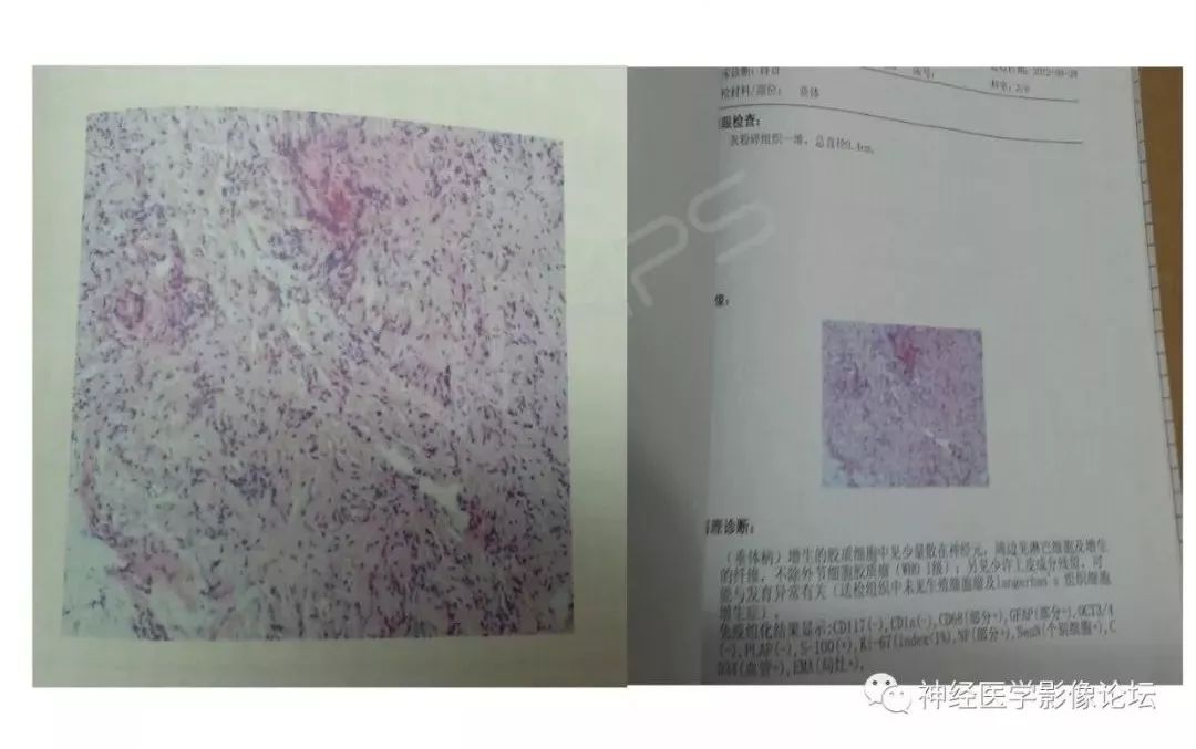 【病例】下丘脑节细胞胶质瘤一例MR影像表现