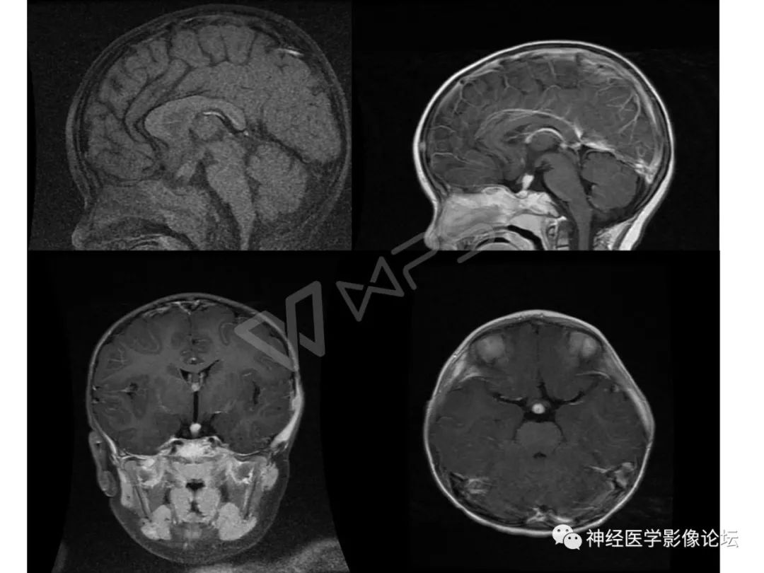 【病例】下丘脑节细胞胶质瘤一例MR影像表现