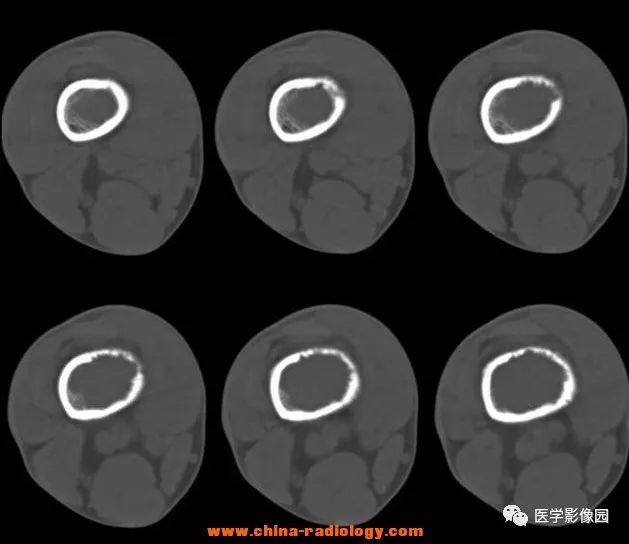 【病例】毛细血管扩张性骨肉瘤1例X线CT影像表现 【病例】毛细血管扩张性骨肉瘤1例X线CT影像表现