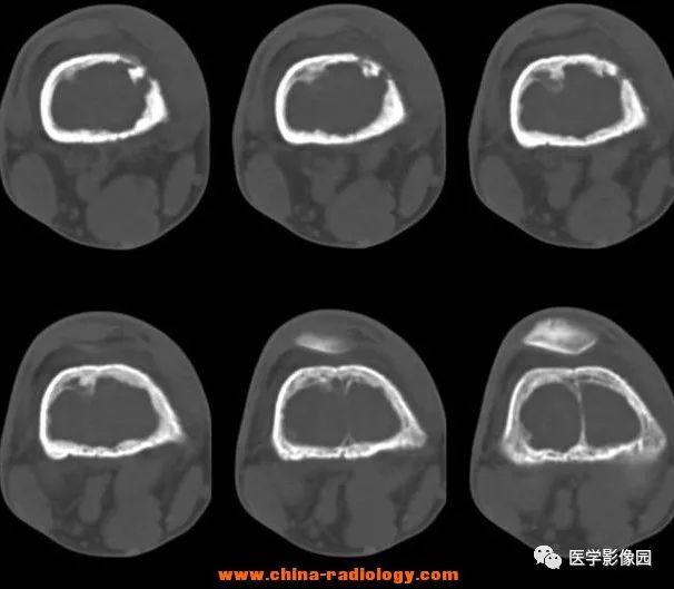 【病例】毛细血管扩张性骨肉瘤1例X线CT影像表现 【病例】毛细血管扩张性骨肉瘤1例X线CT影像表现