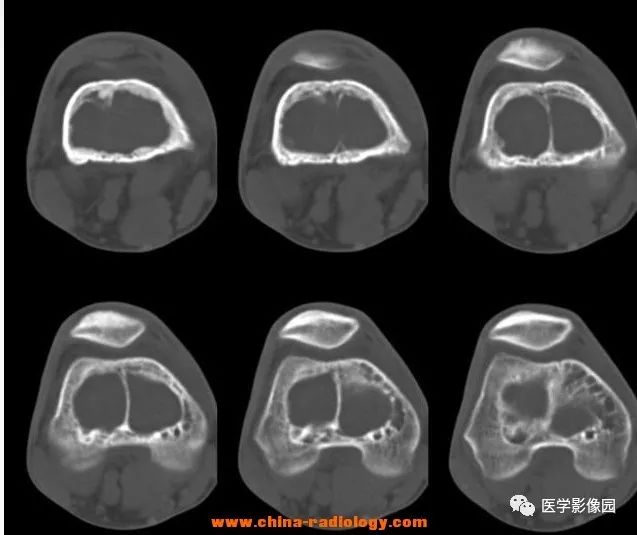 【病例】毛细血管扩张性骨肉瘤1例X线CT影像表现 【病例】毛细血管扩张性骨肉瘤1例X线CT影像表现