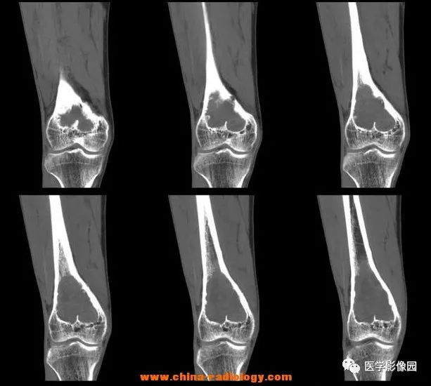 【病例】毛细血管扩张性骨肉瘤1例X线CT影像表现 【病例】毛细血管扩张性骨肉瘤1例X线CT影像表现
