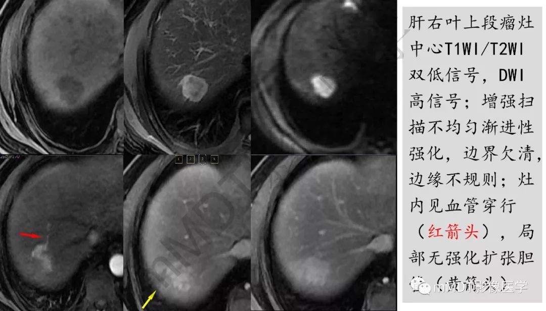 【PPT】肝脏含纤维肿块 【PPT】肝脏含纤维肿块