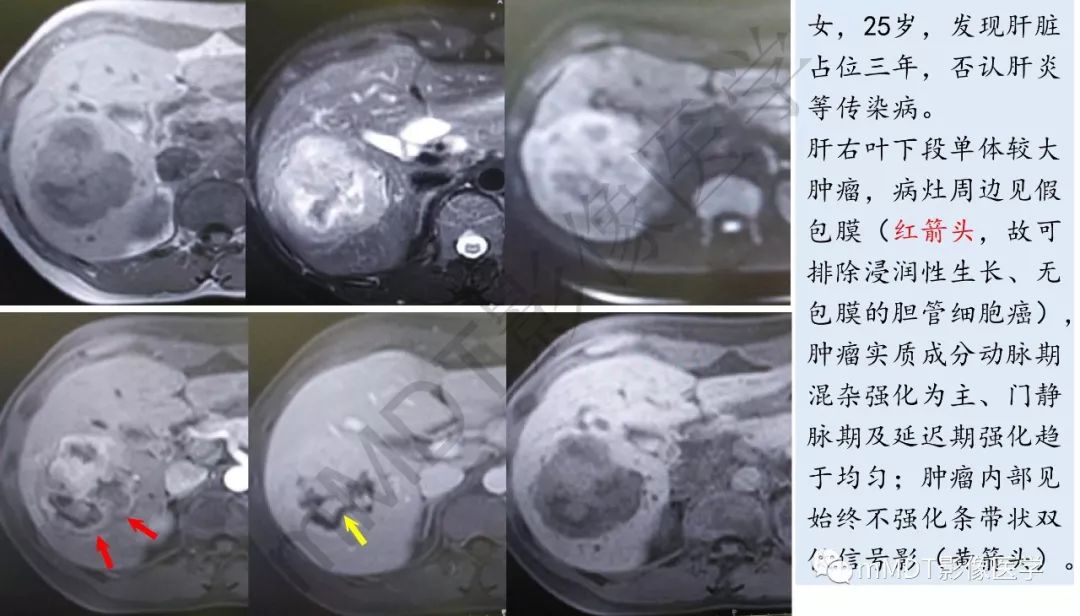【PPT】肝脏含纤维肿块 【PPT】肝脏含纤维肿块