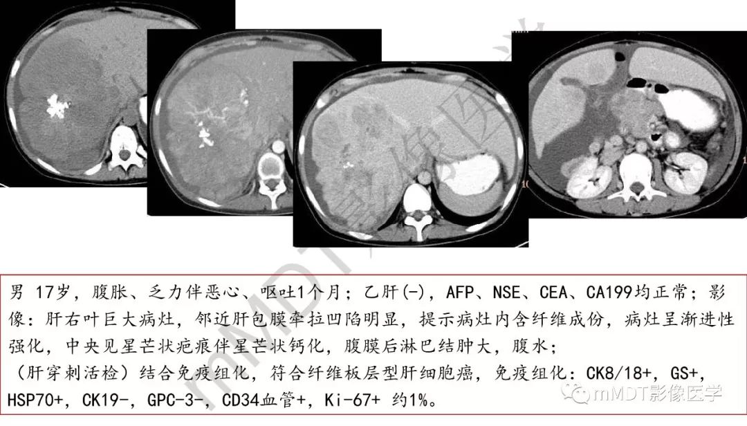 【PPT】肝脏含纤维肿块 【PPT】肝脏含纤维肿块
