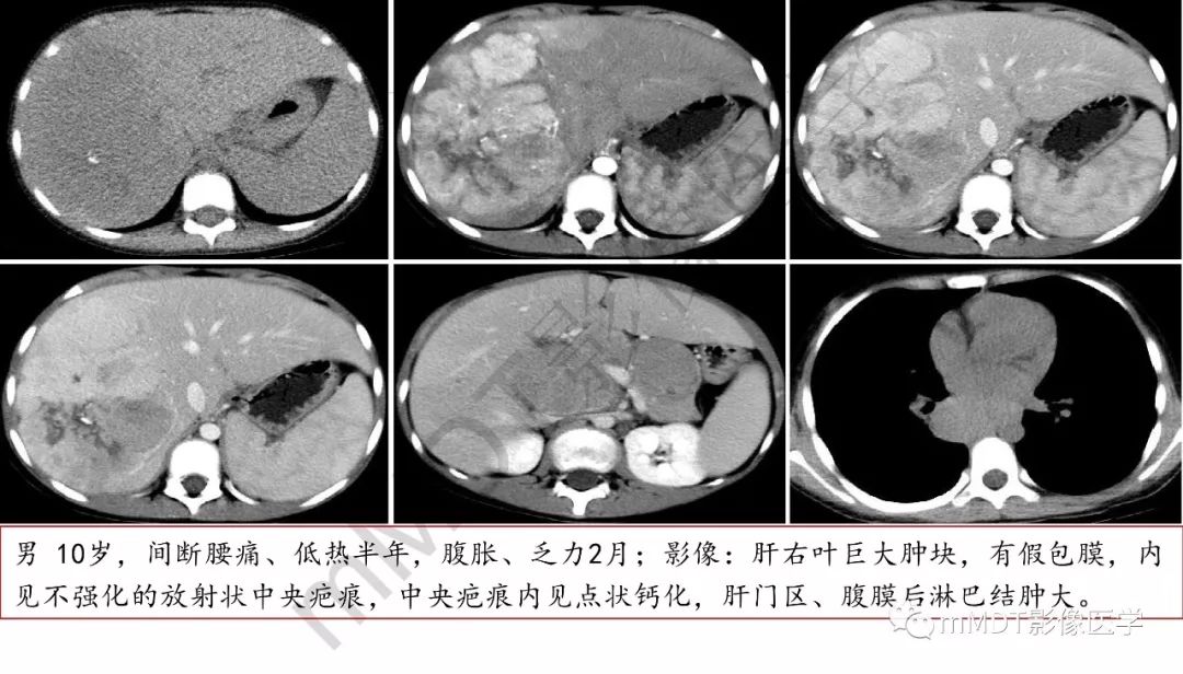 【PPT】肝脏含纤维肿块 【PPT】肝脏含纤维肿块