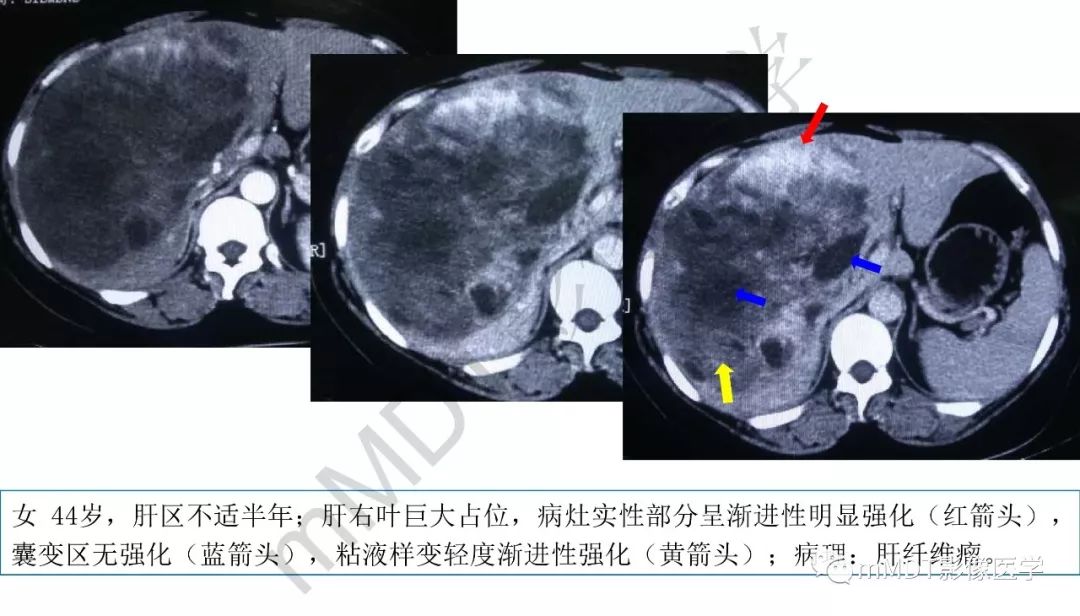 【PPT】肝脏含纤维肿块 【PPT】肝脏含纤维肿块