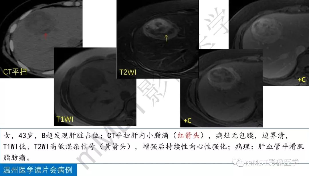 【PPT】肝脏含纤维肿块 【PPT】肝脏含纤维肿块