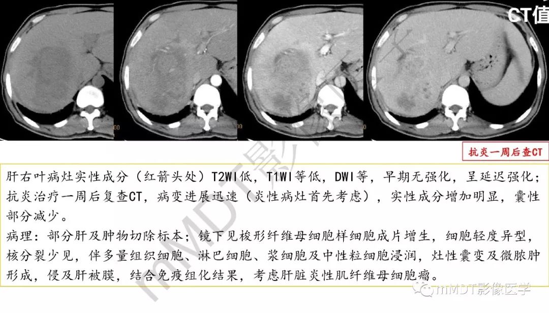 【PPT】肝脏含纤维肿块 【PPT】肝脏含纤维肿块