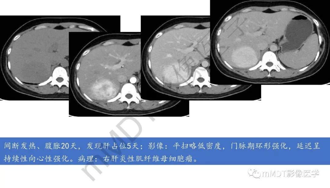 【PPT】肝脏含纤维肿块 【PPT】肝脏含纤维肿块