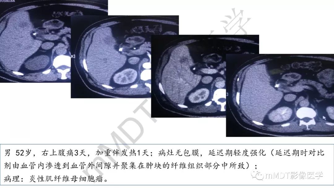 【PPT】肝脏含纤维肿块 【PPT】肝脏含纤维肿块