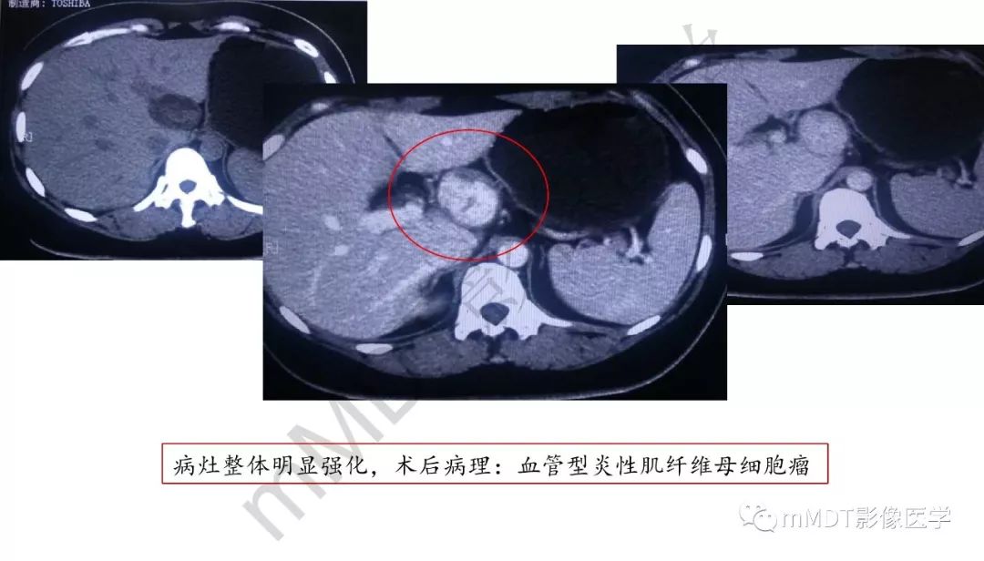 【PPT】肝脏含纤维肿块 【PPT】肝脏含纤维肿块