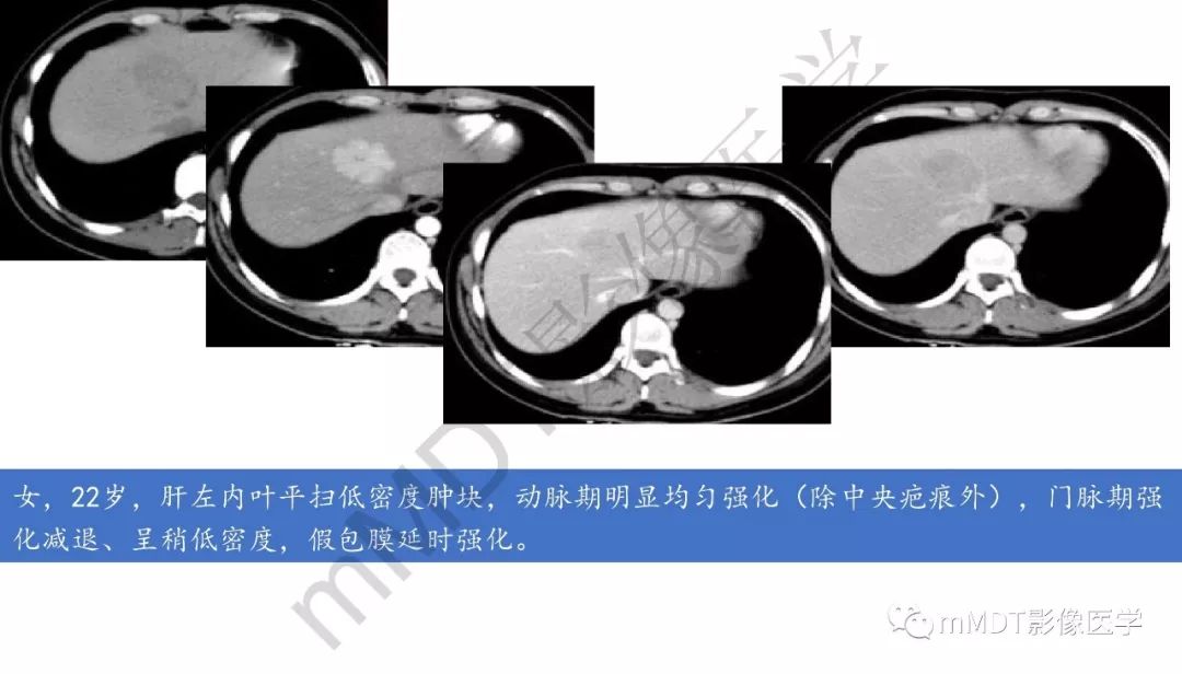 【PPT】肝脏含纤维肿块 【PPT】肝脏含纤维肿块