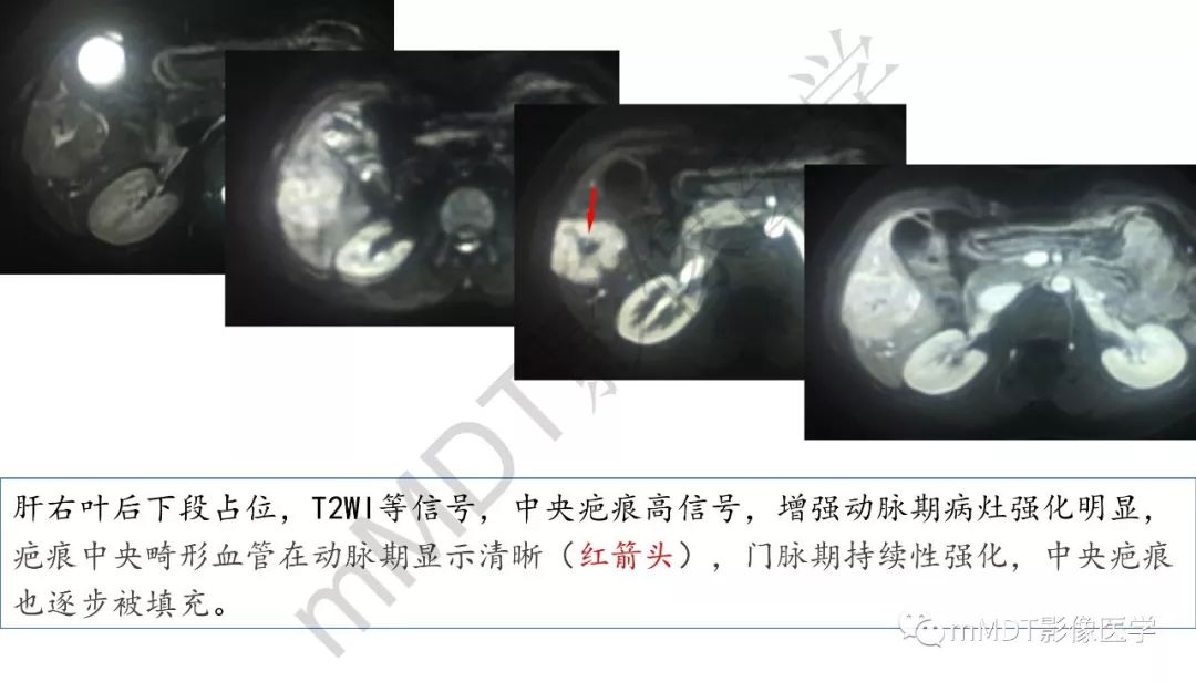 【PPT】肝脏含纤维肿块 【PPT】肝脏含纤维肿块
