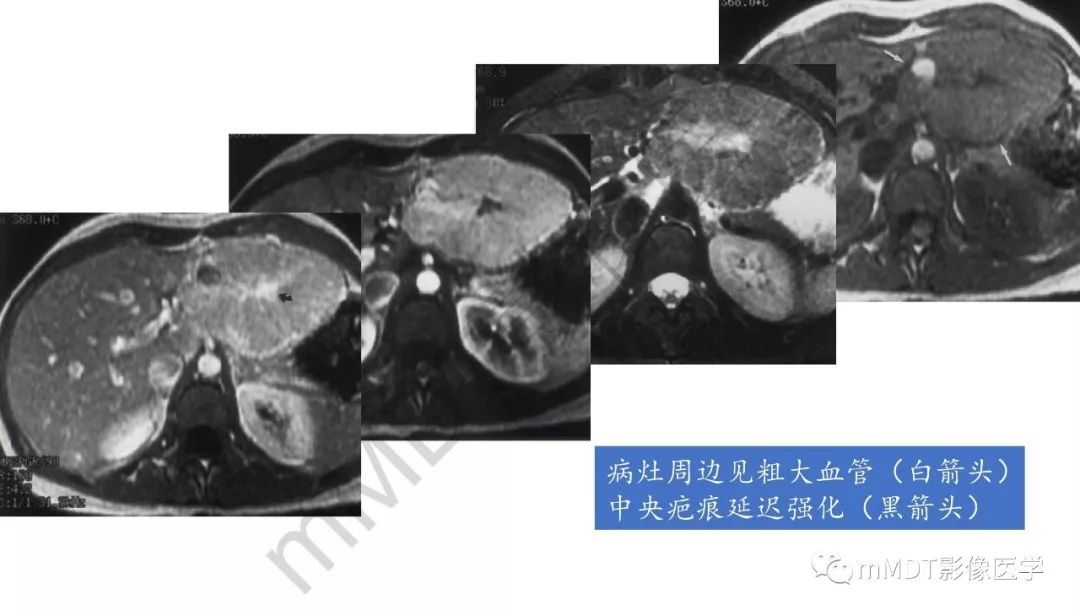 【PPT】肝脏含纤维肿块 【PPT】肝脏含纤维肿块