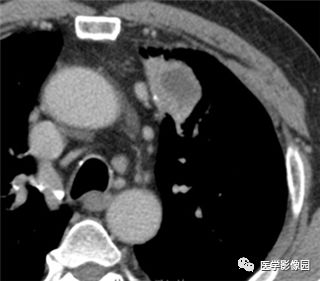 【病例】左上肺炎性肌纤维母细胞瘤1例CT影像表现 【病例】左上肺炎性肌纤维母细胞瘤1例CT影像表现