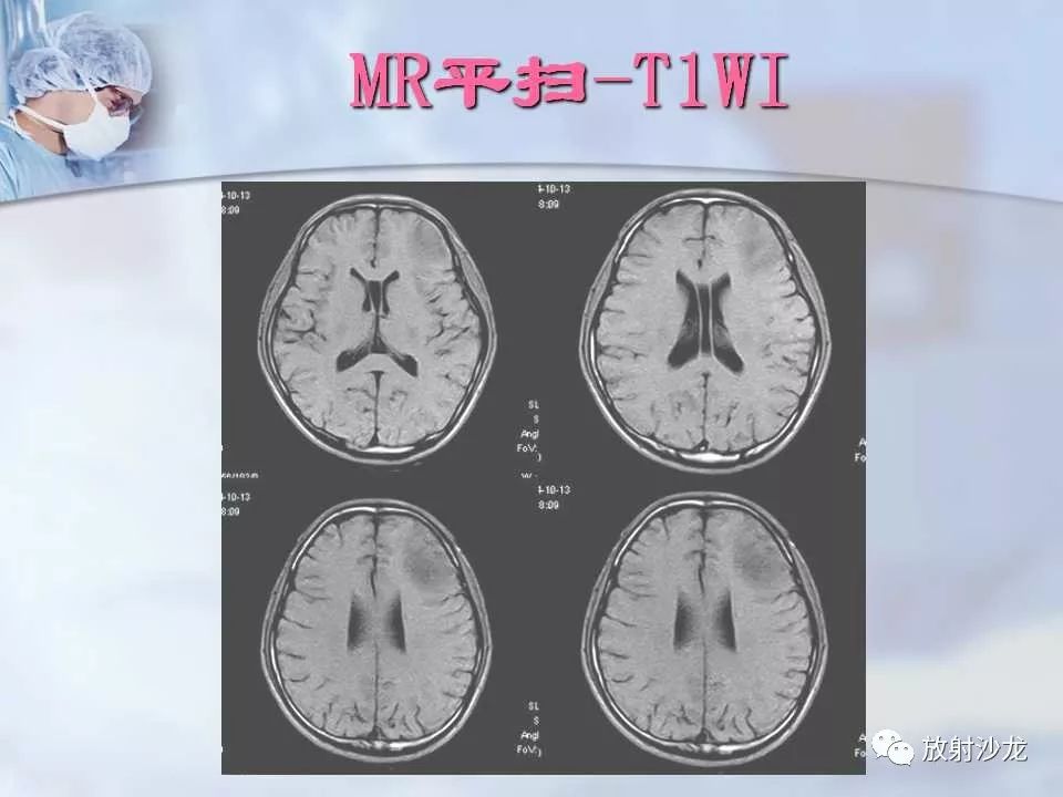 【病例】神经性梅毒1例MR影像表现