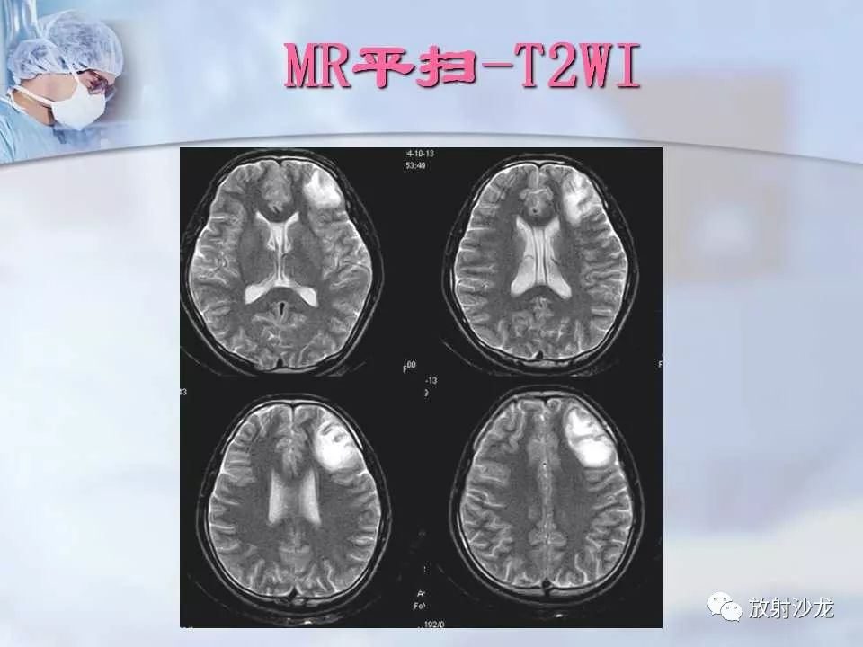 【病例】神经性梅毒1例MR影像表现