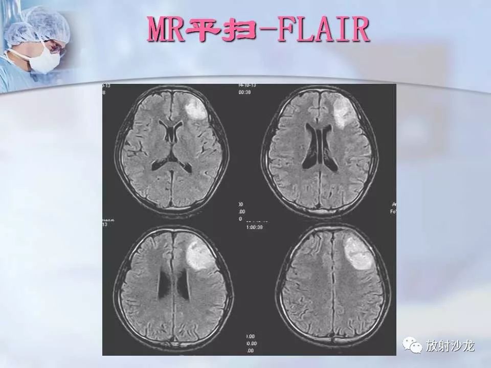 【病例】神经性梅毒1例MR影像表现