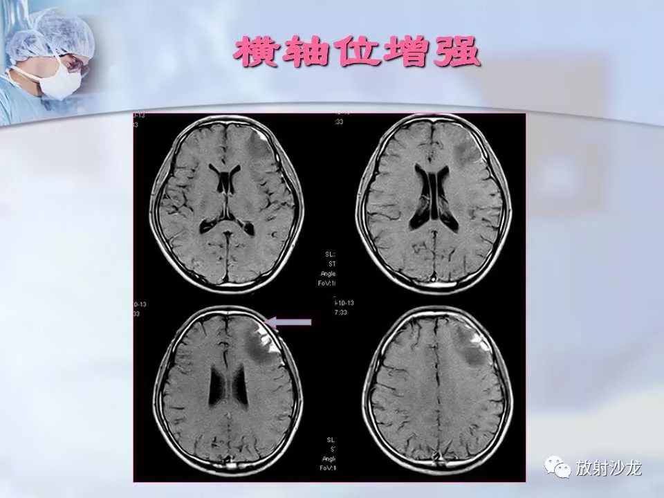 【病例】神经性梅毒1例MR影像表现
