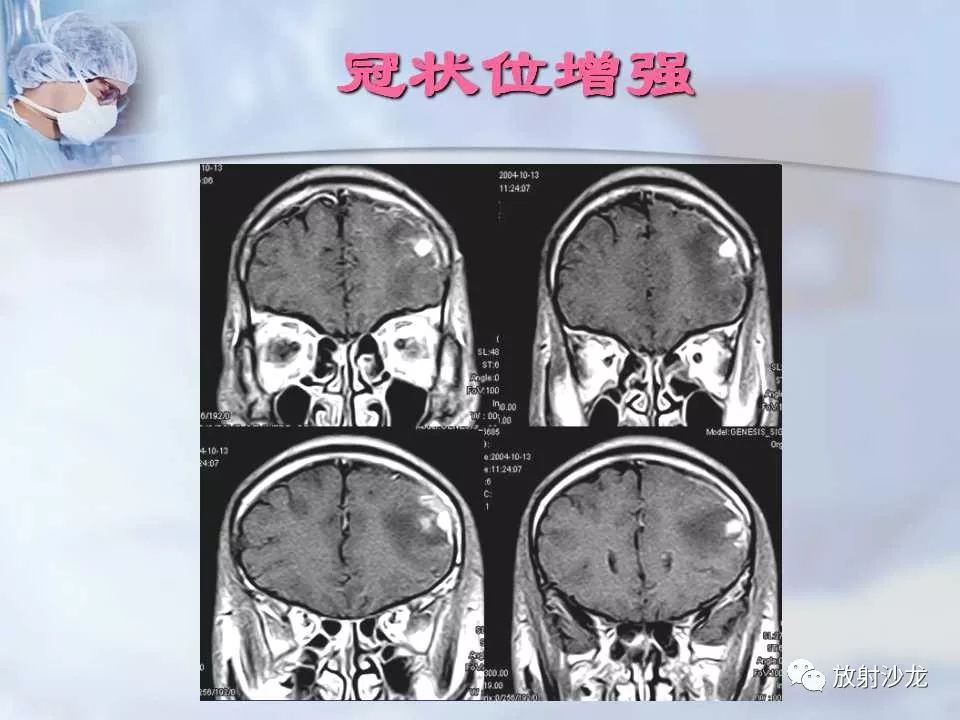 【病例】神经性梅毒1例MR影像表现