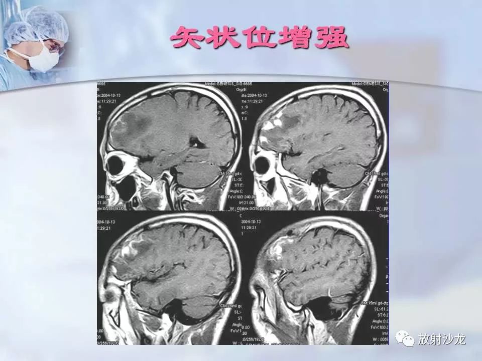 【病例】神经性梅毒1例MR影像表现