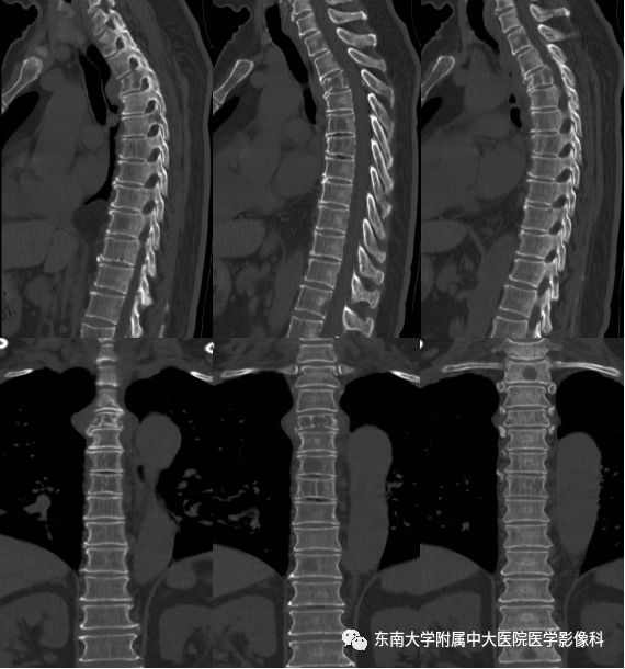 【病例】脊柱浆细胞骨髓瘤1例CT及MR影像表现