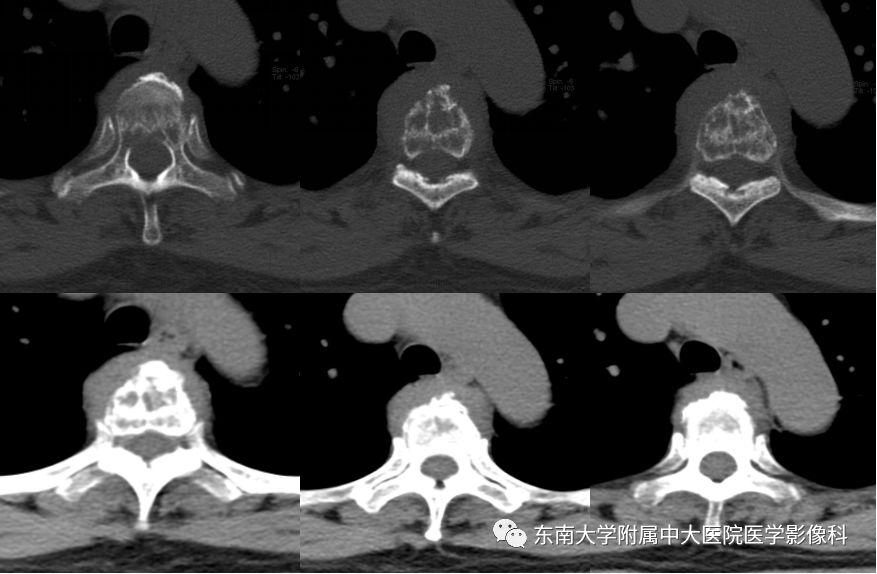 【病例】脊柱浆细胞骨髓瘤1例CT及MR影像表现