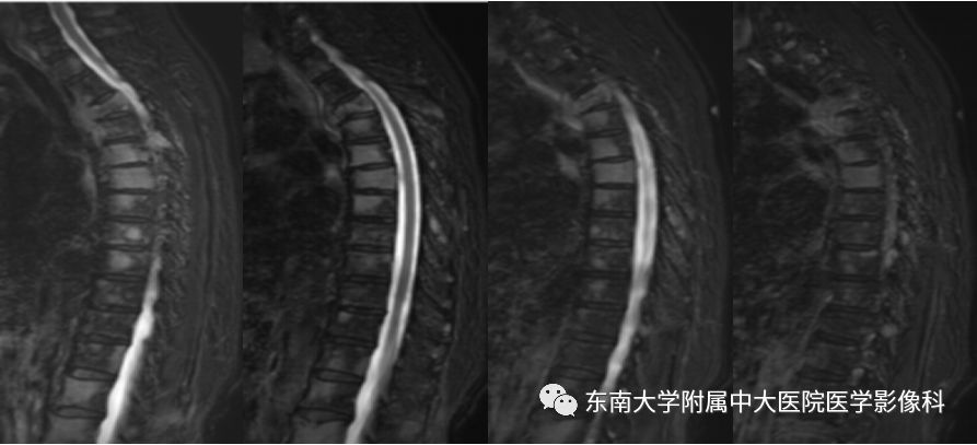 【病例】脊柱浆细胞骨髓瘤1例CT及MR影像表现
