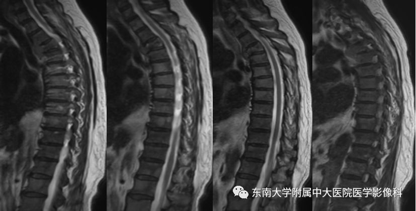 【病例】脊柱浆细胞骨髓瘤1例CT及MR影像表现