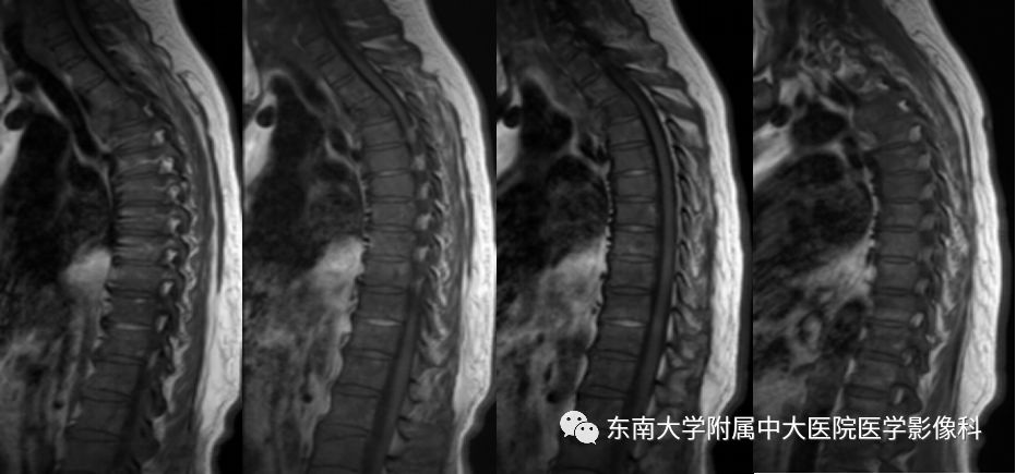 【病例】脊柱浆细胞骨髓瘤1例CT及MR影像表现
