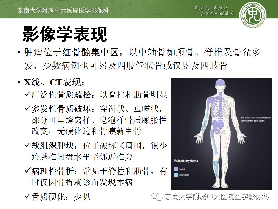 【病例】脊柱浆细胞骨髓瘤1例CT及MR影像表现