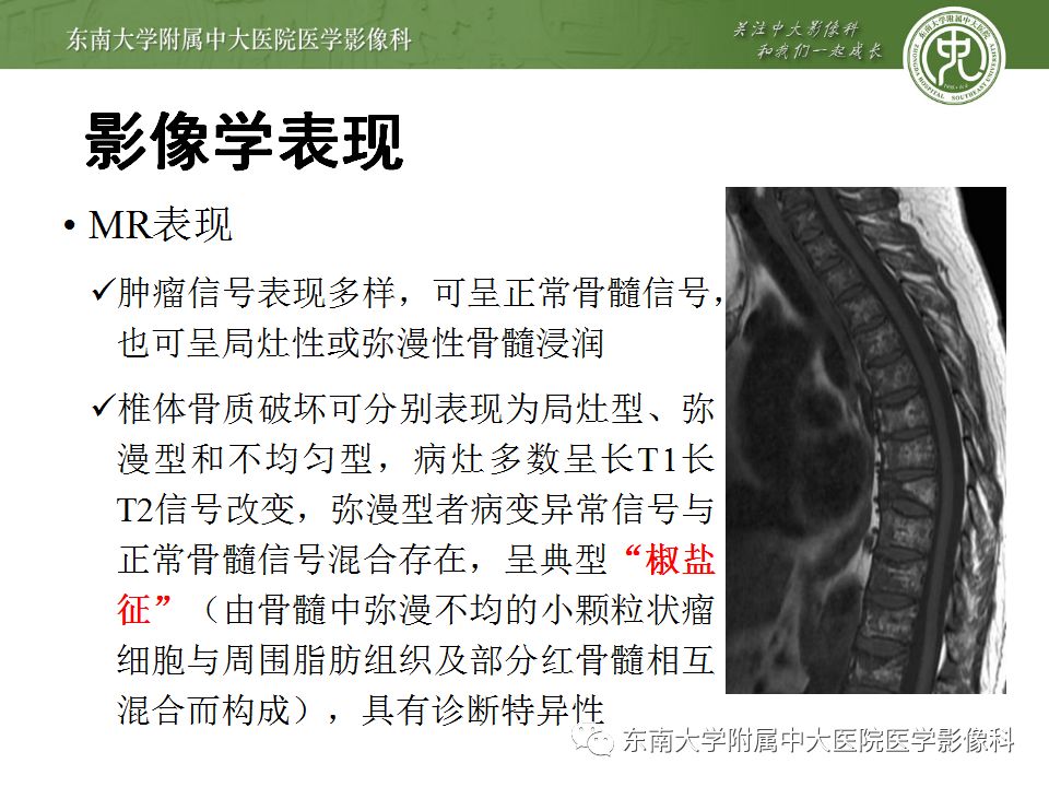 【病例】脊柱浆细胞骨髓瘤1例CT及MR影像表现