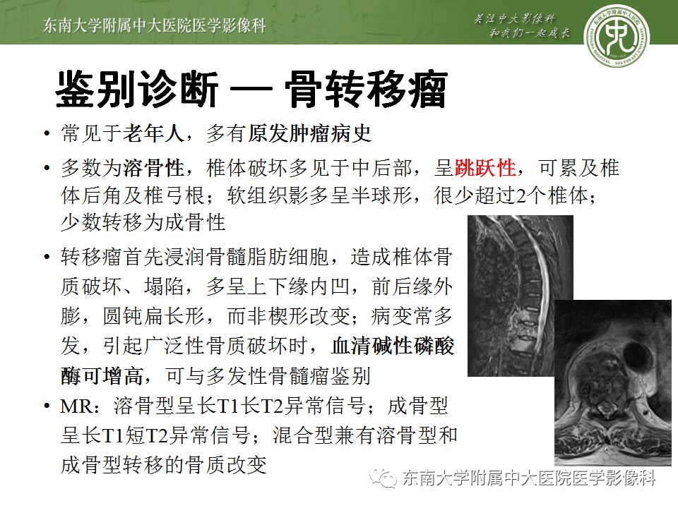 【病例】脊柱浆细胞骨髓瘤1例CT及MR影像表现
