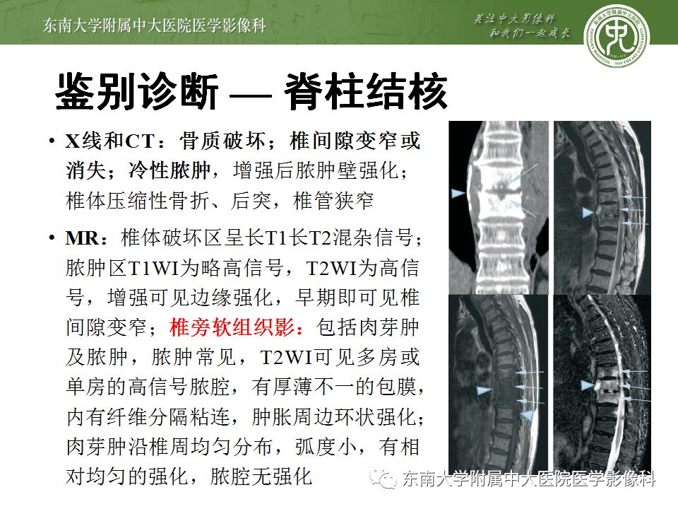 【病例】脊柱浆细胞骨髓瘤1例CT及MR影像表现
