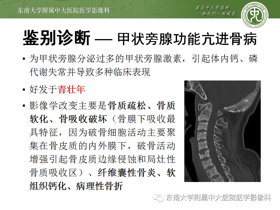 【病例】脊柱浆细胞骨髓瘤1例CT及MR影像表现