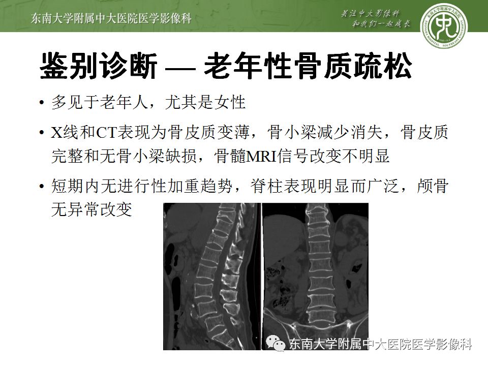 【病例】脊柱浆细胞骨髓瘤1例CT及MR影像表现